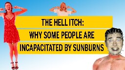 The Hell Itch: Why some people are incapacitated by sunburns